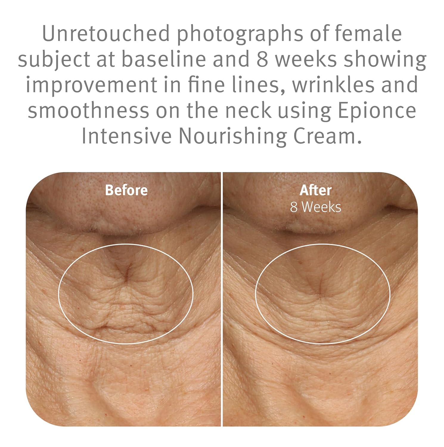 Epionce Intensive Nourishing Cream – Rich Anti-Aging Moisturizer for Face, Neck & Décolletage | Ceramides, Glycerin & Squalene | Targets Fine Lines, Dark Spots & Dryness | Dermatologist Skincare